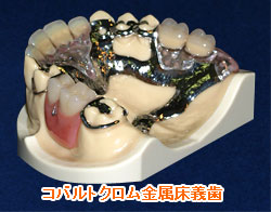 コバルトクロム金属床義歯