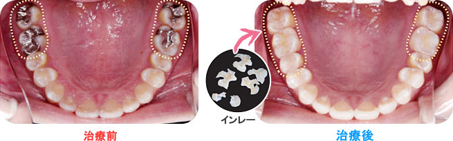 ハイブリッド型歯冠用硬質レジン「ツイニー」による治療例